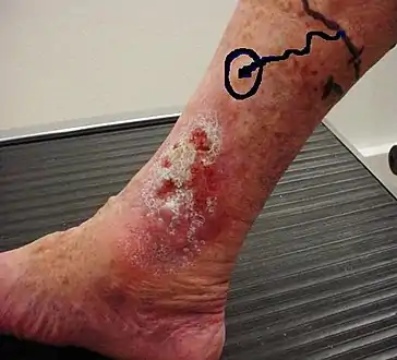 Venous ulcer before surgery