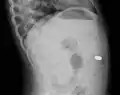 Lateral X ray showing a 9mm battery in the intestines