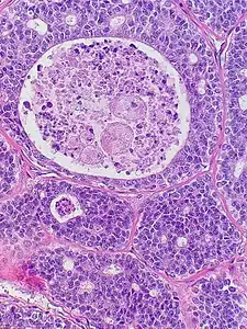 Adenoid cystic carcinoma with comedonecrosis