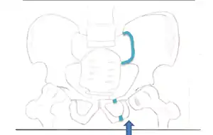 This fracture is best viewed anteriorly, while the other fractures are viewed superiorly. The arrow indicates where the force is coming from, and the colored lines indicate where the break occurs.