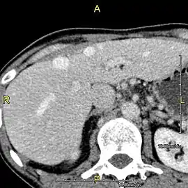 Axial CT image showing anomalous hepatic veins coursing on the liver's subcapsular anterior surface