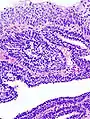 Histopathology representing an inverted papilloma of the urinary bladder that was cystoscopically resected. Hematoxylin and eosion stain.