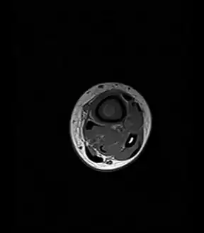 Axial T1-weighted MRI pre-contrast enhancement showing that the intramedullary collection is T1-hyperintense suggesting proteinaceous viscous fluid consistent with infection.