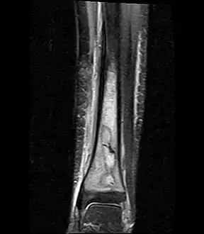 Coronal fat suppressed STIR image showing, bone marrow and subcutaneous edema as well as subperiosteal edema.  The thin hypointense rim surrounding the intramedullary collection represents the reactive interface between the abscess and the body's attempt to wall it off.