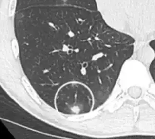 subpleural nodule.