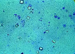 Urine microscopy showing calcium oxalate crystals in the urine. The octahedral crystal morphology is clearly visible.