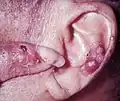 Gouty tophi presenting as nodules on the finger and helix of the ear