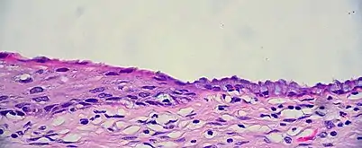 The squamocolumnar junction of the cervix, with abrupt transition: The ectocervix, with its stratified squamous epithelium, is visible on the left. Simple columnar epithelium, typical of the endocervix, is visible on the right. A layer of connective tissue is visible under both types of epithelium.