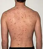 The back of a 30-year-old male after five days of the rash