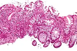 Cryptitis. H&E stain.