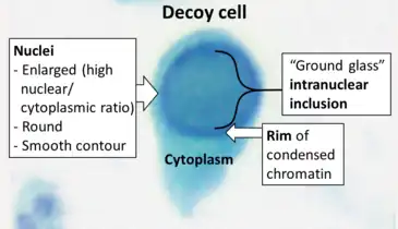 Decoy cells, which are virally infected epithelial cells that may look like carcinoma (Pap stain).