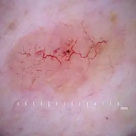 Dermoscopy showing telangiectatic vessels