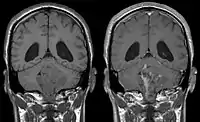 Ependymoma of 4.ventricle in MRI. Left without, right with contrast-enhancement.