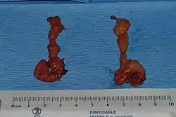 Cheek reduction: The buccal fat pads extracted from a patient who underwent bilateral cheek reduction