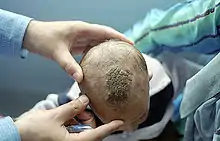 A large brown colored plaque on the top of a child's head