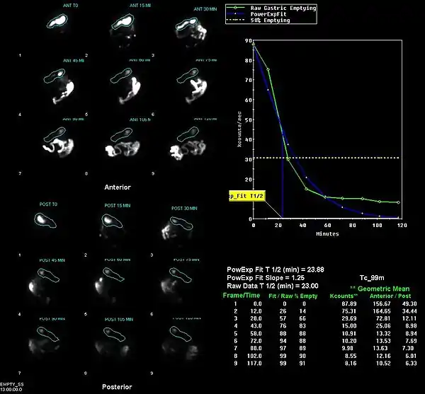 GastricEmptying.jpg