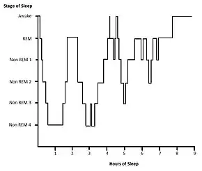 Example hypnogram for a normal, healthy adult. Within the first hour of sleep SWS is displayed. Cycles of REM and NREM sleep proceed. During the third cycle of sleep there are two brief wake states. During the second half of the sleep period more REM sleep is displayed and there is little SWS detected.