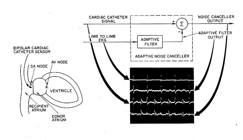 Extracting Remnant Pacemaker Signal from Heart transplant ECG