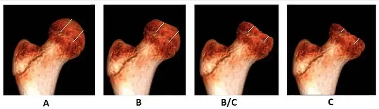 Figure 3A. Herring lateral pillar classification