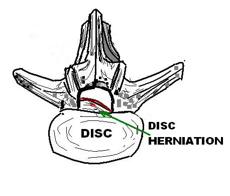 LUMBAR_DISC_HERNIATION