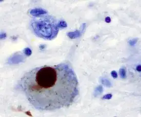 Brain cells stained in blue. The largest one, a neurone, with an approximately circular form, has a brown circular body inside it. The brown body is about 40% the diameter of the cell in which it appears.