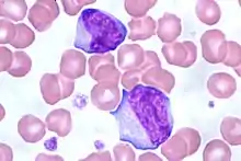 Reactive lymphocytes in infectious mononucleosis