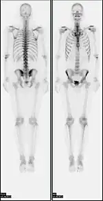 A nuclear medicine whole body bone scan. The nuclear medicine whole body bone scan is generally used in evaluations of various bone-related pathology, such as for bone pain, stress fracture, nonmalignant bone lesions, bone infections, or the spread of cancer to the bone.