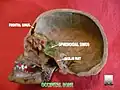 Occipital bone