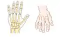 Bone (left) and clinical (right) changes of the hand in osteoarthritis