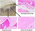 Pathology of avascular necrosis, with a photograph of a cross-section of the involved bone at top left. The reactive zone shows irregular trebaculae with empty lacunae, and fibrosis of the marrow space.