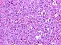 Salt-and-pepper chromatin (pheochromocytoma). H&E stain.