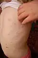 A 3-year-old girl with a chickenpox rash on her torso