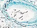 Angioinvasive pulmonary aspergillosis