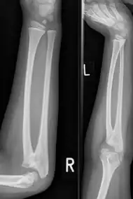 Plain radiograph showing fusion of the radius and ulna