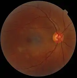 A fundus photograph showing the macula as a spot to the left. The optic disc is the area on the right where blood vessels converge. The grey, more diffuse spot in the centre is a shadow artifact.