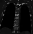 Sclerosis of the bones of the thoracic spine due to prostate cancer metastases (CT image)