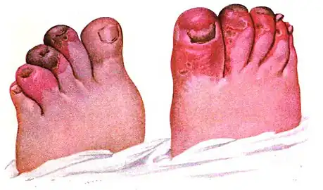 Tinea corporis, toes