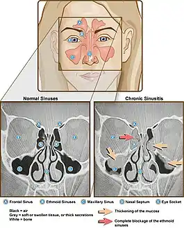 CT of chronic sinusitis