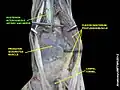 Posterior interosseous artery and nerve