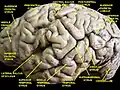 Cerebrum. Lateral view. Deep dissection.