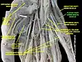 Flexor digiti minimi brevis muscle