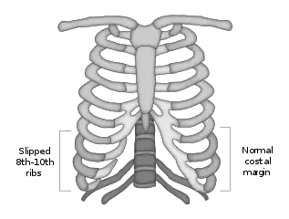 Slipping Rib Syndrome Example