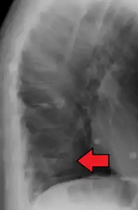 Compression fracture of T12