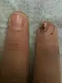 A fingertip injured by a table saw.