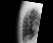 Confluent ossification of multiple contiguous vertebral bodies in diffuse idiopathic skeletal hyperostosis (DISH)