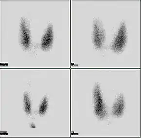 Thyroid scan with iodine-123 for evaluation of hyperthyroidism.