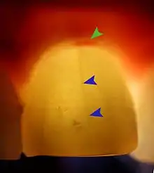 Transillumination demonstrating fracture