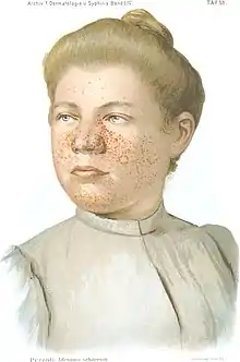 Head and shoulders of a young lady wearing a blouse, looking slightly to her right. Her light brown hair is tied up. Her face is covered in red pimples, particularly the cheeks around her nose, the fleshy part of her nose, and her chin.