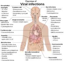 A photograph of the upper body of a man labelled with the names of viruses that infect the different parts